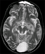 MRI of a brain